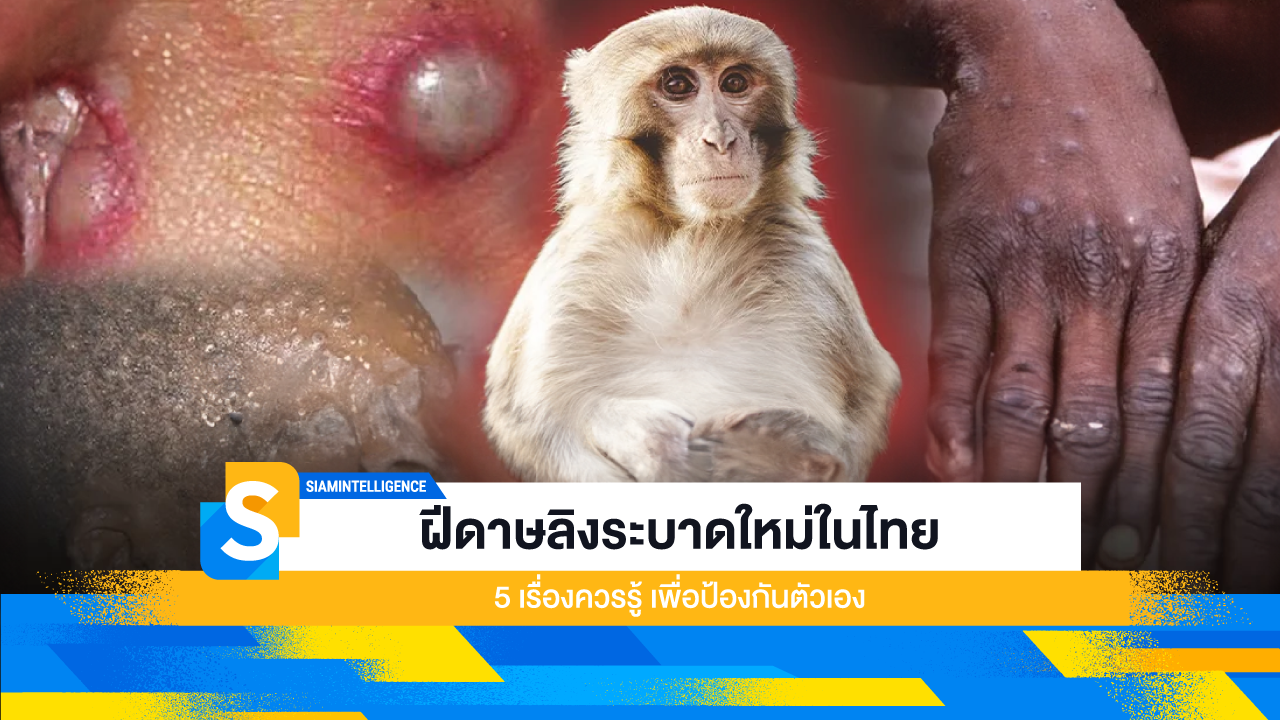 "ฝีดาษลิงระบาดใหม่ในไทย 5 เรื่องควรรู้ เพื่อป้องกันตัวเอง"